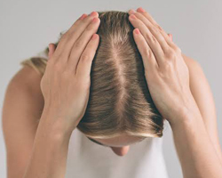 Herbal Treatment for Alopecia